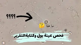 فحص عينة بول بها اسطوانات وكتابة التقرير casts in urine