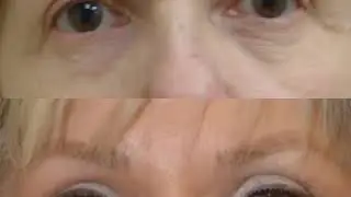 Blepharoplasty and Brow Lift by Dr. Renato Calabria