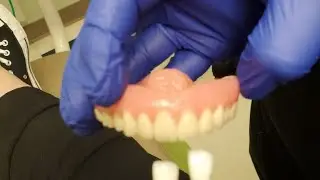Denture Wearer..Getting Molds for Permanent Dentures