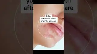 If you struggle with acne, especially around your mouth,