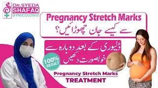 How To Remove Stretch Marks | Stretch Marks on Belly After Delivery |- Treatment Of Stretch Marks