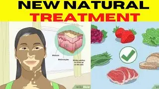 New Treatment for Vitiligo 2022 - (Natural Treatment) 自然療法