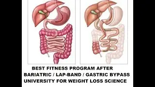 BEST FITNESS PROGRAM AFTER GASTRIC BYPASS  LAPBAND   BARIATRIC SURGERY   BRUCE WAYNE   UNIVERSITY FO