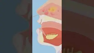 Функциональная эндоскопическая хирургия околоносовых пазух (FESS) &mdash; чего ожидать и советы по восс...