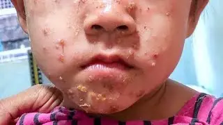 Mengatasi impetigo pada anak dengan salep gentamicin #obat #impetigo #gentamicin 