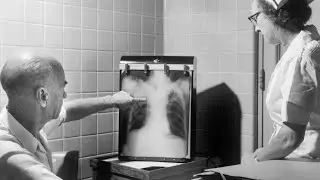 SMARCA4 Deficient Tumour: A New & Deadly Thoracic Cancer