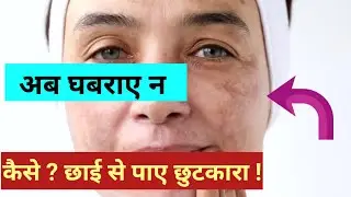 #Dr. BH NASSIR अब सिवान में ही चेहरे कि छाई से छुटकारा दिलाएंगे! छाई कोई बड़ी बिमारी न हैं ! #skin