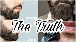 Does Derma Rollers Actually Work (THE TRUTH) Beard Growth Updates !!