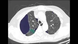 Asvide: Automatically categorized pattern-based map of axial non-contrast chest CT image of...