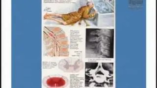 Acute Spinal Cord Injury: Devastating but Treatable Disorder
