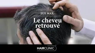 Greffe de cheveux FUE MAX : la solution sans cicatrice pour une chevelure naturelle !