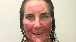 Photodynamic Therapy (PDT) for skin cancer