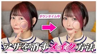 【緊急】クマ、内出血、アザ消し！種類別の隠し方！整形ダウンタイム中のメイク方法！【おすすめコンシーラー】