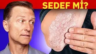 Sedef Hastalığı Tedavisi: Sedef İ&ccedil;in En İyi 3 Y&ouml;ntem | Dr. Berg T&uuml;rk&ccedil;e