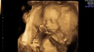 Isla lizzie Wills 4D scan, (24 weeks)