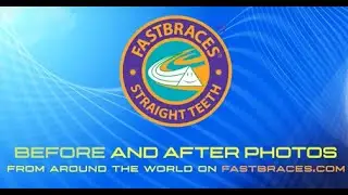 Fastbraces® Before and After Photos from Around The World