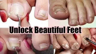 Reveal Radiant Feet: Captivating Pedicure Compilation for Impacted, Ingrown, and Pincer Toenails!