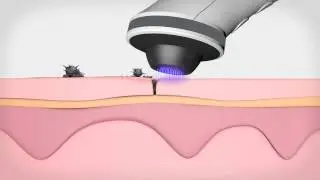 Plasma Shower(SeoulinMediCare)