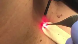 Skin Tag Removal - CO2 Laser