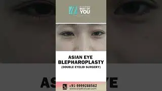 Asian eye Blepharoplasty | Double Eyelid Surgery in Delhi | Dr. PK Talwar