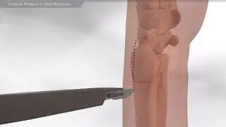 Хирургическая фиксация переломов запястья