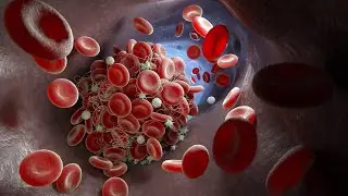 Deep vein thrombosis: Symptoms, causes and treatments