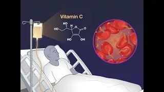Intravenous Vitamin C for Sepsis in the ICU | NEJM