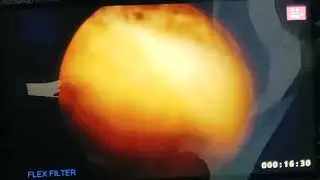 Cystolithotripsy of bladder stone using stone punch