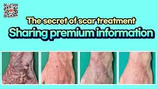 Scars are gone, SUDDENLY? #scarremoval #burn #burnscar  #burnscars #scartreatment #lasertherapy