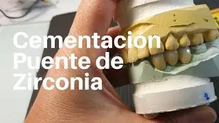 PUENTE de ZIRCONIA👅 Posterior CEMENTACION #Puentezirconia #Puentedental