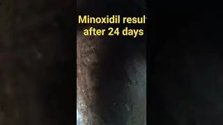 minoxidil result review day 24#minoxidil #minoxidilresult #hair #hairtransplant #dandruff #dandruff