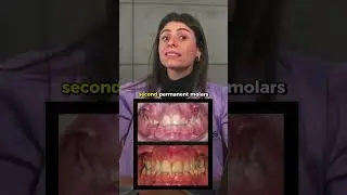 Should we treat deep bite in children? 🤔