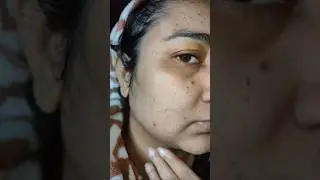 Mid Day Update 😱 पिम्पल्स अभी तक क्यों नहीं गए? सच सामने आया@sweetyvlog