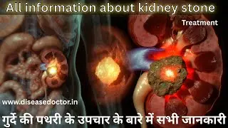 Got Kidney Stone Questions? Ask Me Anything! Treatment, Diet & Prevention