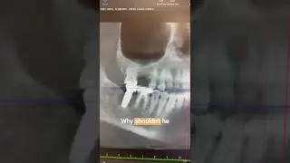 My Patient Already Had 2 Titanium Implants, why I didn't Recommend 2 More #shorts