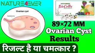 Biocellix se ovarian cyst khatam | Nature4Ever ka kamaal ! BioCellix Stem Cell Results | Nature4Ever