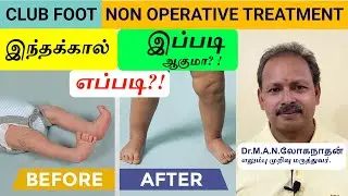குழந்தைகள் வளைபாத பாதிப்பும்..சரிசெய்யும் முறையும் | Club Foot in Children | Dr. Loganathan