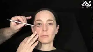 3 - Krähenfüße mit Botox behandeln | Dr. Günther