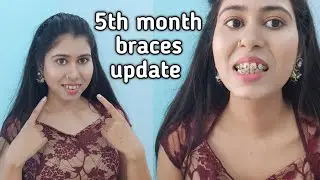 5 month braces journey update | लग गई पूरे दातों में पावर चैन | matalic braces Full information