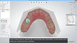 3Shape Clear Aligner Studio - Intersection Visualization and Collision Detection BR PT