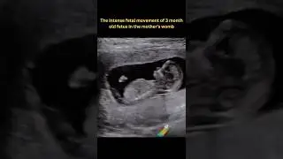 The Intense fetal movement process of a 22week fetus in the mom's belly#pregnancy#fetus #ultrasound