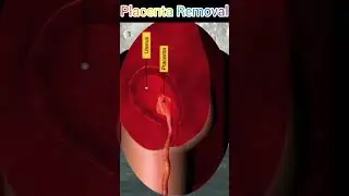 #pregnant#pregnancy#placenta#removal#viralvideo#baby#womb#babygirl#today#todaynews#trending #art