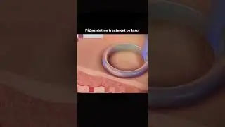 &ldquo;Fix Pigmentation Fast with Laser!&rdquo;👉 Read the full description for more .