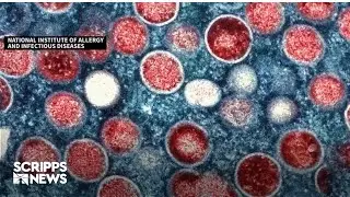 CDC warns of potential mpox resurgence