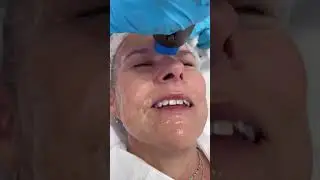 XTherma . Best energy device in 2025 ! #botox #skincare #beauty #filler #duet