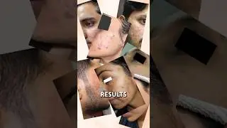 SkinQ Acne Mask: Clinically Proven to Reduce Acne in 3 Uses | How to treat Pimples | #shorts