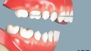 Anterior Openbite with Appliance