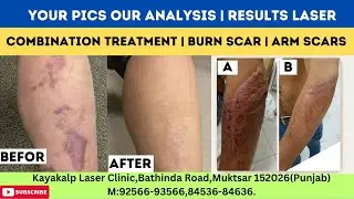 Your Pics our analysis | Results Laser Combination Treatment | Burn Scar | Arm Scars