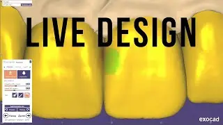 Live Exocad. Live Wax up. Mockup. Моделирование экзокад. зубной техник