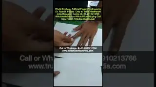 Finger Tips Repairing by Silicone Finger Prosthesis tips #artificialfinger #anaplastology